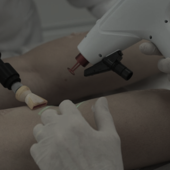 Tratamento de Varizes com Laser